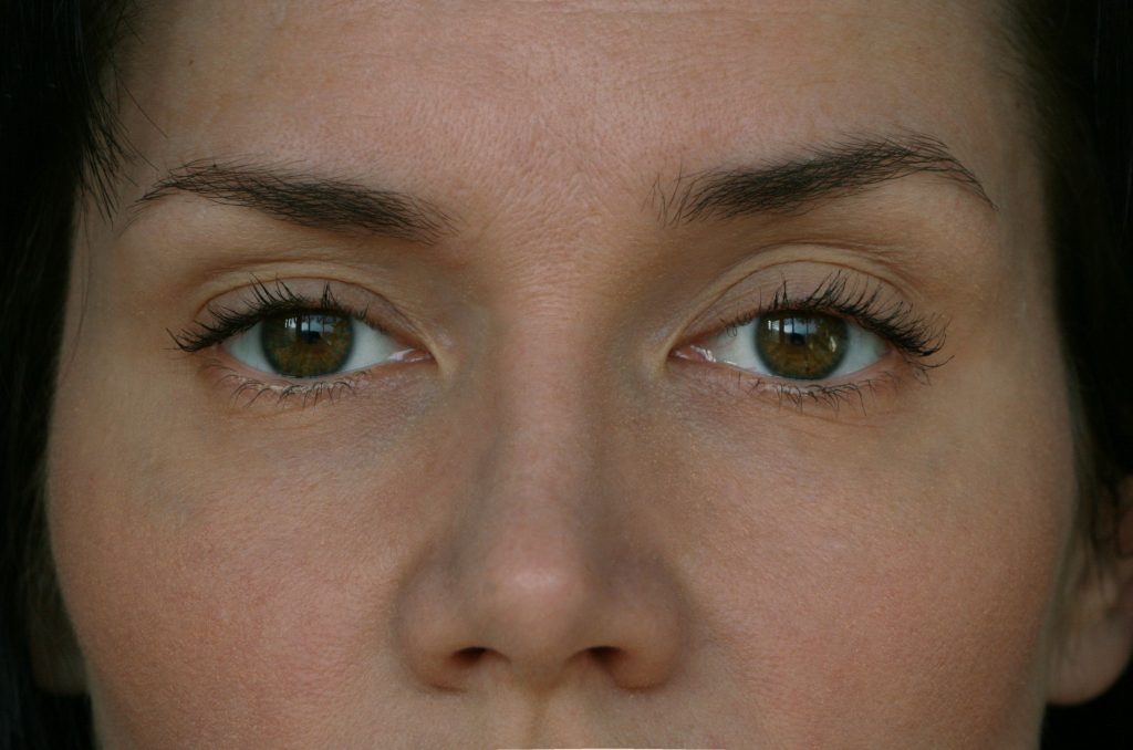 How to Lift Eyelids and Excess Eyelid Skin