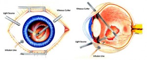 after retina detachment surgery should you your eye